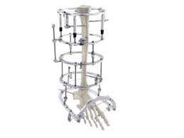 ilizarov rufino.jpeg